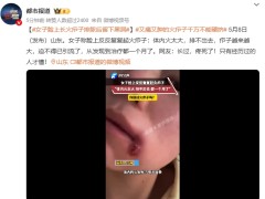 女子脸上长火疖子排脓后留下黑洞 这是什么情况？（图）