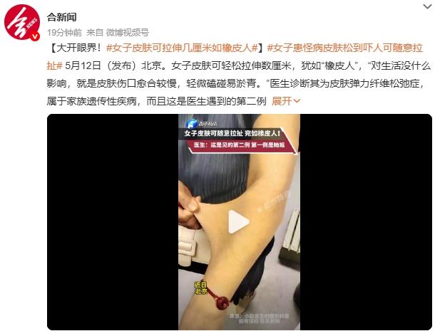 女子皮肤可拉伸几厘米如橡皮人