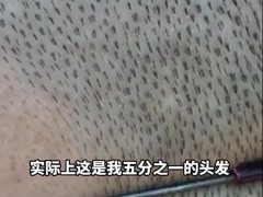 女子因发量太多剃掉五分之四头发 网友：你剩下的已经比我全头都多了！
