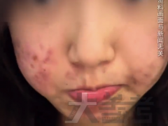 18岁女孩1天3杯奶茶脸上长满红色脓包 甜食奶类都是痘痘的催化剂